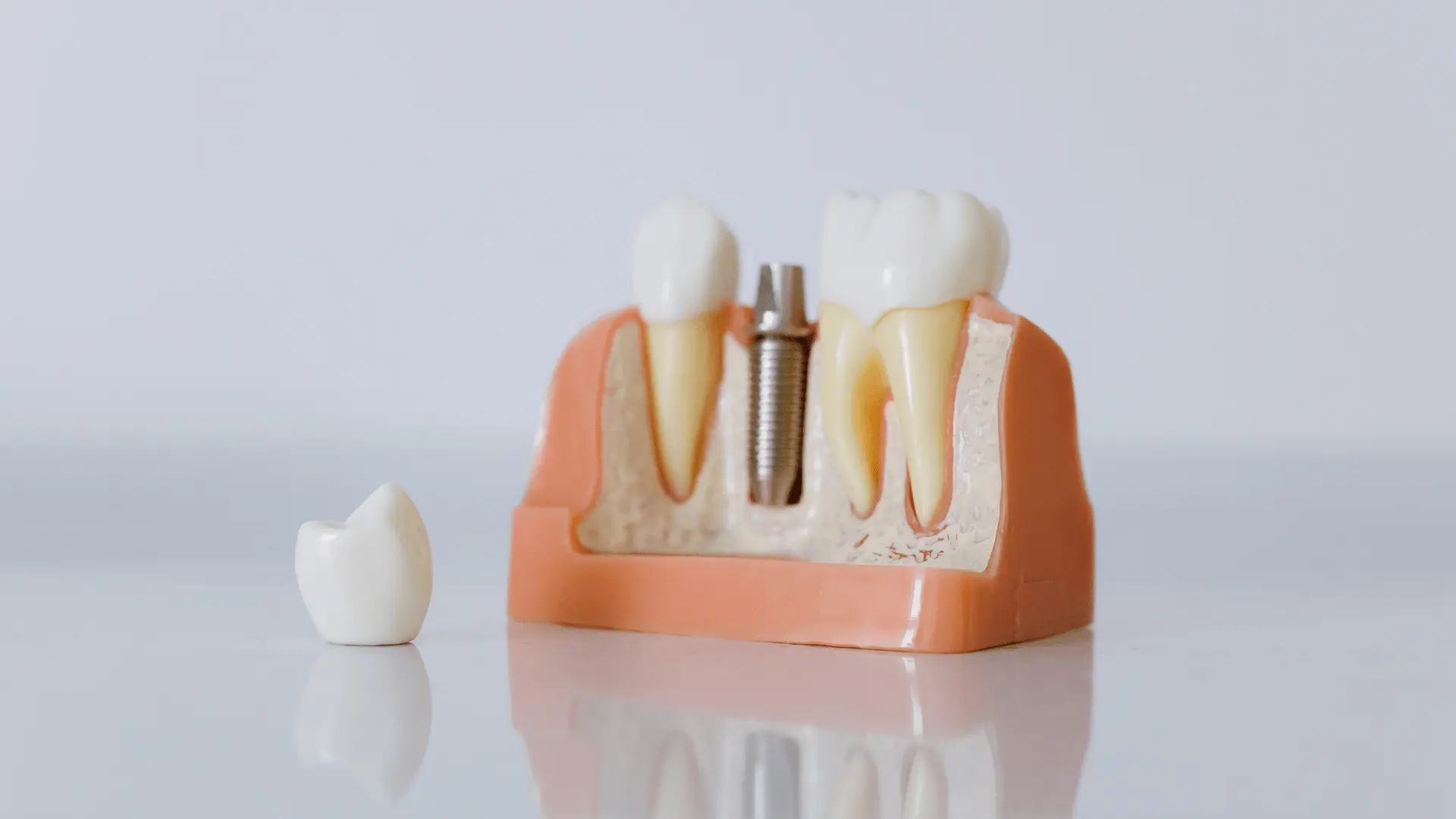 All-on-4 Technique vs. Traditional Dental Implant Surgery: What's the Difference?