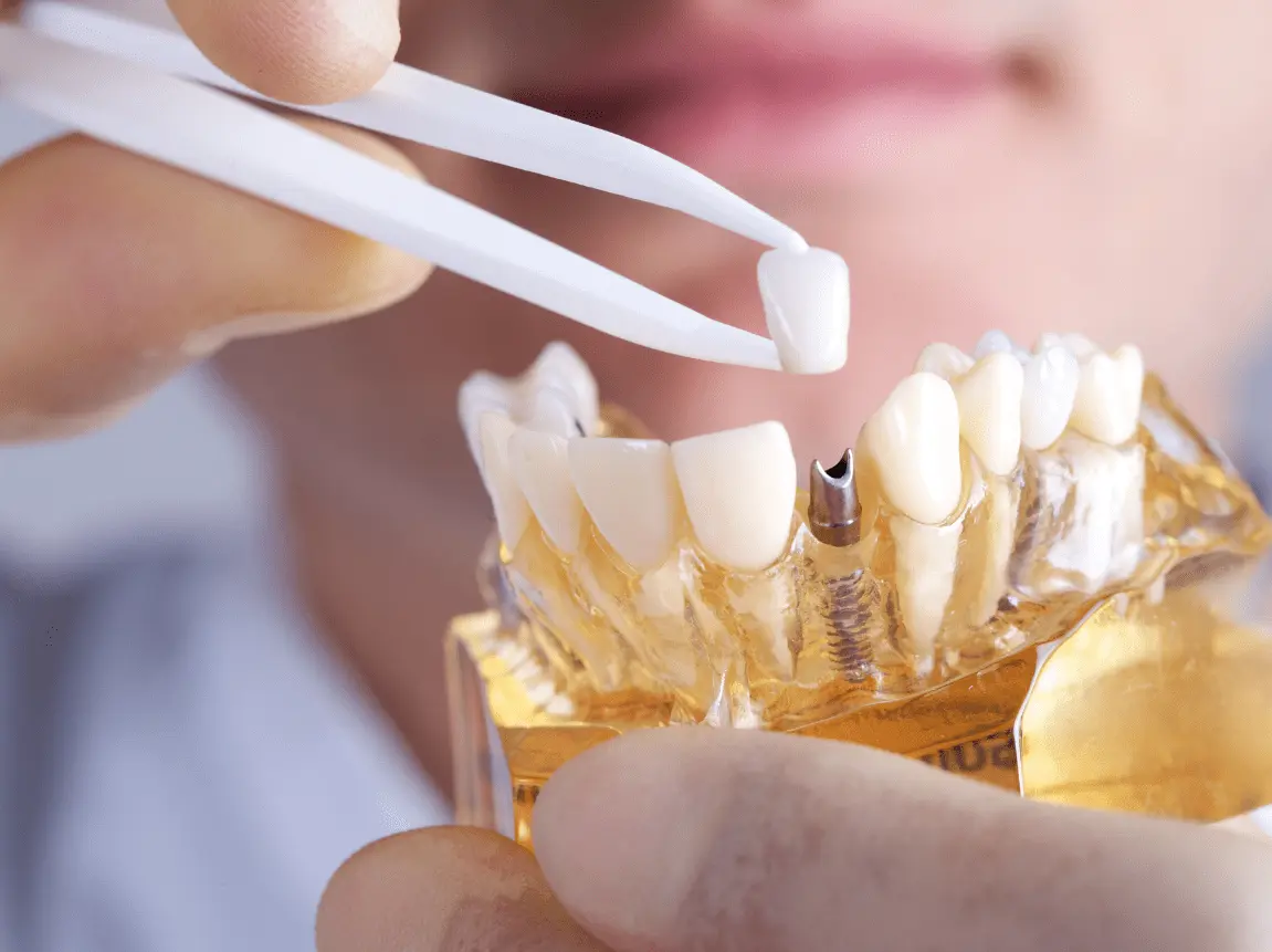 Dr Kasapoglu Implant Treatment: For a Permanent and Aesthetic Smile