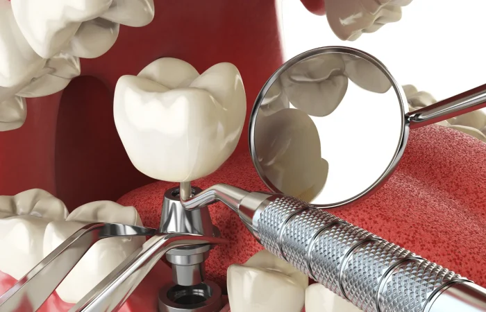 Les implants dentaires personnalisés : Une approche sur mesure pour un sourire parfait