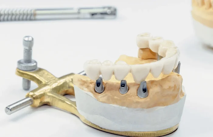 Les implants dentaires personnalisés : Une approche sur mesure pour un sourire parfait